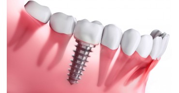 Dental İmplantlar Başarılı Mıdır?